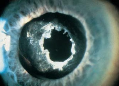 YAG kapsulotomia (zaćma wtórna)