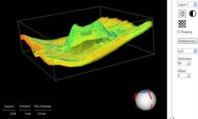 Optyczna koherentna tomografia