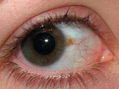 Cyfrowa fotografia przedniego odcinka oka